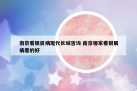 南京看銀屑病現(xiàn)代長城咨詢 南京哪家看銀屑病看的好