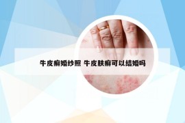 牛皮癬婚紗照 牛皮膚癬可以結(jié)婚嗎