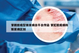 掌踱膿皰型銀屑病會(huì)不會(huì)傳染 掌跎膿皰病和銀屑病區(qū)別