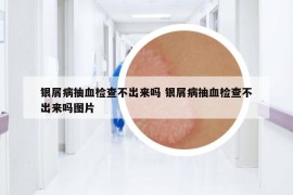 銀屑病抽血檢查不出來嗎 銀屑病抽血檢查不出來嗎圖片