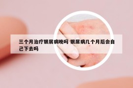 三個(gè)月治療銀屑病晚嗎 銀屑病幾個(gè)月后會(huì)自己下去嗎