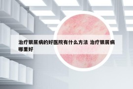 治療銀屑病的好醫(yī)院有什么方法 治療銀屑病哪里好