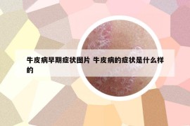 牛皮病早期癥狀圖片 牛皮病的癥狀是什么樣的