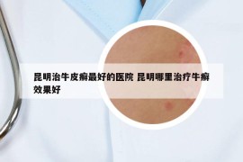 昆明治牛皮癬最好的醫(yī)院 昆明哪里治療牛癬效果好