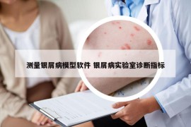 測量銀屑病模型軟件 銀屑病實驗室診斷指標(biāo)