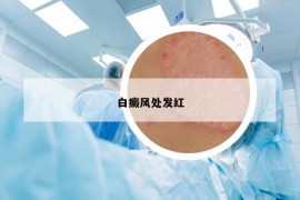 白癜風(fēng)處發(fā)紅