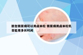 膿包銀屑病可以用鹵米松 銀屑病用鹵米松乳膏能用多長時間