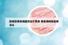 肢端型銀屑病醫(yī)院治療費用 銀屑病四肢能根治么
