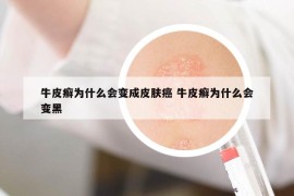 牛皮癬為什么會變成皮膚癌 牛皮癬為什么會變黑