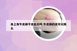 身上有牛皮癬干皮能扣嗎 牛皮癬的皮可以撕么