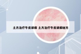 土方治療牛皮頑癬 土方治療牛皮頑癬秘方