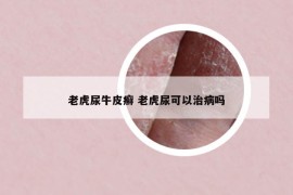 老虎尿牛皮癬 老虎尿可以治病嗎