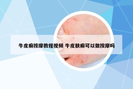 牛皮癬按摩教程視頻 牛皮膚癬可以做按摩嗎