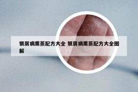 銀屑病熏蒸配方大全 銀屑病熏蒸配方大全圖解
