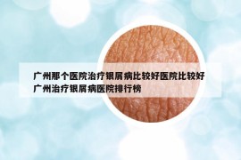 廣州那個醫(yī)院治療銀屑病比較好醫(yī)院比較好 廣州治療銀屑病醫(yī)院排行榜