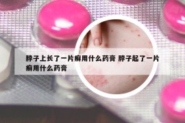 脖子上長了一片癬用什么藥膏 脖子起了一片癬用什么藥膏