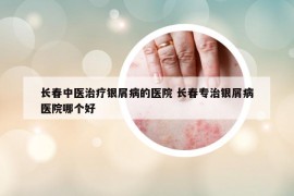 長春中醫(yī)治療銀屑病的醫(yī)院 長春專治銀屑病醫(yī)院哪個好