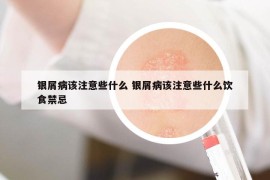 銀屑病該注意些什么 銀屑病該注意些什么飲食禁忌