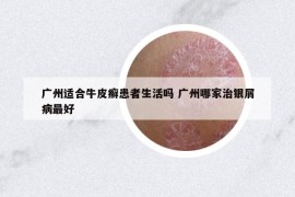 廣州適合牛皮癬患者生活嗎 廣州哪家治銀屑病最好