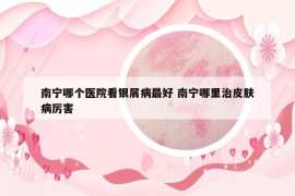 南寧哪個醫(yī)院看銀屑病最好 南寧哪里治皮膚病厲害
