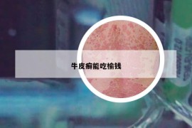 牛皮癬能吃榆錢