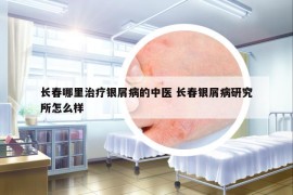 長春哪里治療銀屑病的中醫(yī) 長春銀屑病研究所怎么樣