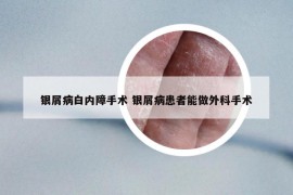 銀屑病白內(nèi)障手術(shù) 銀屑病患者能做外科手術(shù)