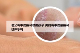 老公有牛皮癬可以要孩子 男的有牛皮病癬可以懷孕嗎