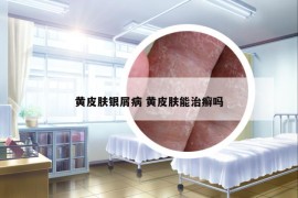 黃皮膚銀屑病 黃皮膚能治癬嗎