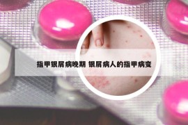 指甲銀屑病晚期 銀屑病人的指甲病變