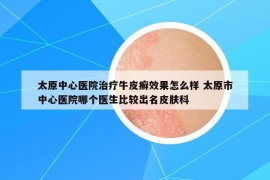 太原中心醫(yī)院治療牛皮癬效果怎么樣 太原市中心醫(yī)院哪個醫(yī)生比較出名皮膚科
