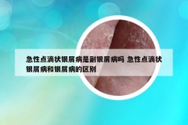 急性點(diǎn)滴狀銀屑病是副銀屑病嗎 急性點(diǎn)滴狀銀屑病和銀屑病的區(qū)別