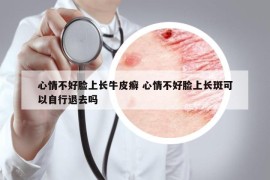 心情不好臉上長(zhǎng)牛皮癬 心情不好臉上長(zhǎng)斑可以自行退去嗎