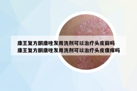 康王復(fù)方酮康唑發(fā)用洗劑可以治療頭皮蘚嗎 康王復(fù)方酮康唑發(fā)用洗劑可以治療頭皮瘙癢嗎