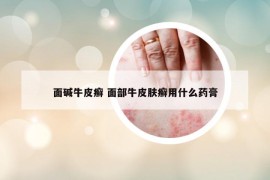 面堿牛皮癬 面部牛皮膚癬用什么藥膏