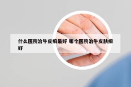 什么醫(yī)院治牛皮癬最好 哪個(gè)醫(yī)院治牛皮膚癬好