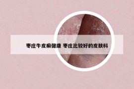 棗莊牛皮癬健康 棗莊比較好的皮膚科