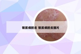 銀屑病脫皮 銀屑病脫皮圖片