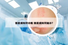 銀屑病如何診斷 銀屑病如何確診?