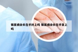 銀屑病會長在手肘上嗎 銀屑病會長在手背上嗎