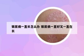 銀屑病一直長怎么辦 銀屑病一直好又一直在長