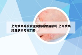 上海武夷路皮膚醫(yī)院能看銀屑病嗎 上海武夷路皮膚科專家門診