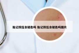 胎記按壓會褪色嗎 胎記按壓會褪色嗎圖片