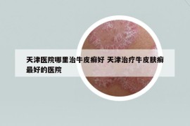 天津醫(yī)院哪里治牛皮癬好 天津治療牛皮膚癬最好的醫(yī)院