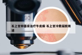 石上甘抑菌膏治療牛皮癬 石上甘冷敷凝膠用途