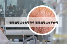 銀屑病可以吃龜苓膏嗎 銀屑病可以吃零食嗎