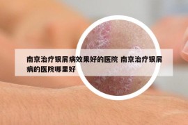 南京治療銀屑病效果好的醫(yī)院 南京治療銀屑病的醫(yī)院哪里好