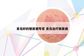 青島好的銀屑病專家 青島治療銀屑病