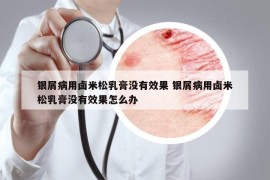 銀屑病用鹵米松乳膏沒有效果 銀屑病用鹵米松乳膏沒有效果怎么辦