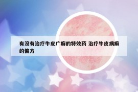 有沒有治療牛皮廣癬的特效藥 治療牛皮病癬的偏方